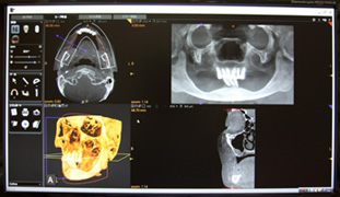 歯科用CT装置　"トロフィーパン・プロ"